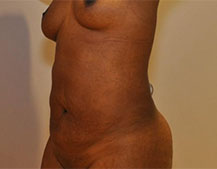Liposuction Three Months After