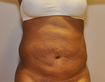Liposuction Two Weeks After