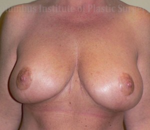 Breast Lift (Mastopexy)