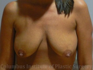 Breast Lift (Mastopexy)