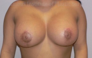 Breast Lift and Augmentation (Implants)