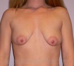 Mini Mastopexy and Augmentation (Breast Lift with Implants)