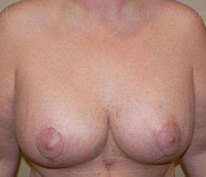 Breast Lift with Augmentation after Weight Loss