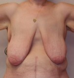 Breast Lift with Augmentation after Weight Loss