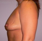 Breast Augmentation - Do I Need a Lift