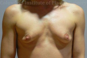 Breast Augmentation - Do I Need a Lift