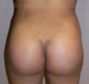 Buttock (Gluteal) Augmentation with Implants