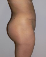 Buttock (Gluteal) Augmentation with Implants