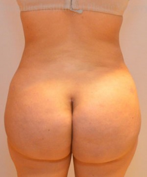 Gluteal (Butt) Augmentation with Fat Grafting (Brazilian Butt Lift)