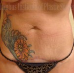 Mini Abdominoplasty (Mini Tummy Tuck)