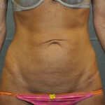 Mini Abdominoplasty (Mini Tummy Tuck)