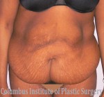 Abdominoplasty after Weight Loss