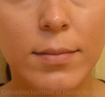 Lip Augmentation (Fillers and Implants)