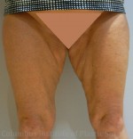 Thighplasty (Thigh Lift)