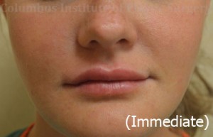 Lip Augmentation (Fillers and Implants)