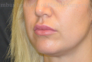 Fillers and Botox