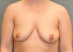 Breast Augmentation - 400cc-500cc