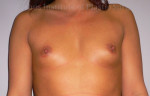 Actual Breast Implant Patients