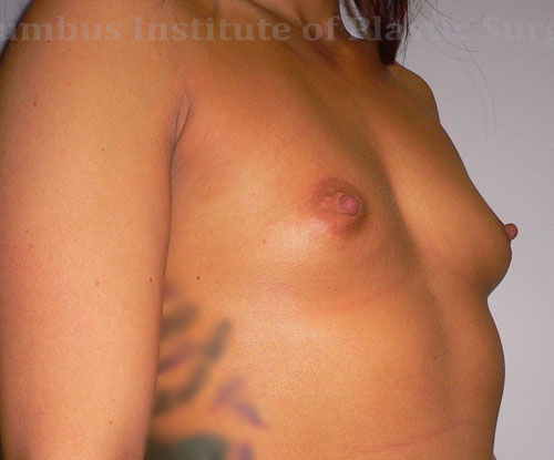 Breast Implants Results Columbus