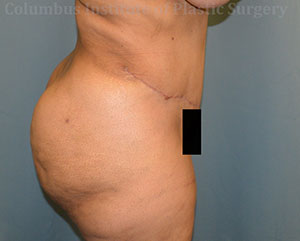 Abdominoplasty (Tummy Tuck)