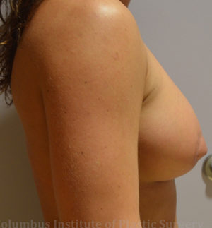 Mini Mastopexy and Augmentation (Breast Lift with Implants)