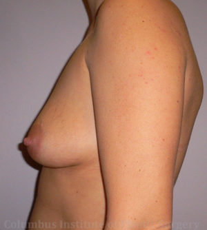 Breast Augmentation - 300cc-400cc