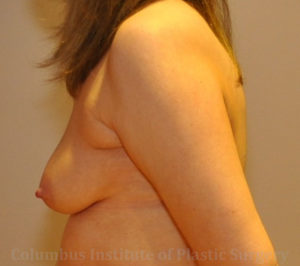 Breast Augmentation with Fat Grafting