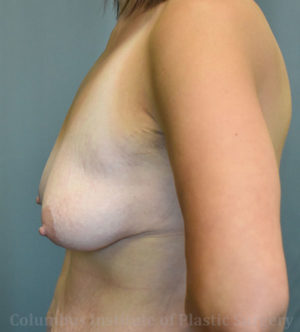 Breast Lift and Augmentation (Implants)
