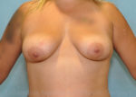 Breast Augmentation - 700cc-800cc
