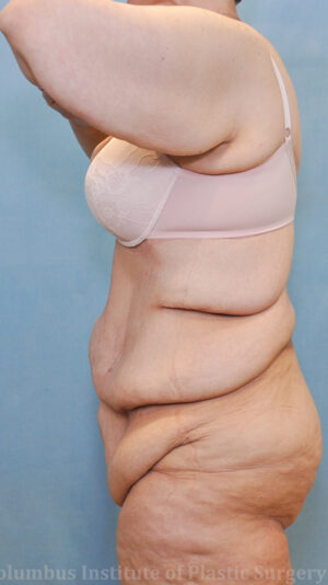 Abdominoplasty after Weight Loss
