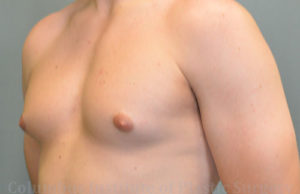 Gynecomastia Before and After Results