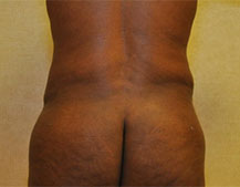 Liposuction One Month After
