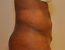 Liposuction Two Weeks After