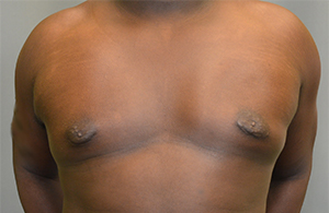 Gynecomastia Before and After Results