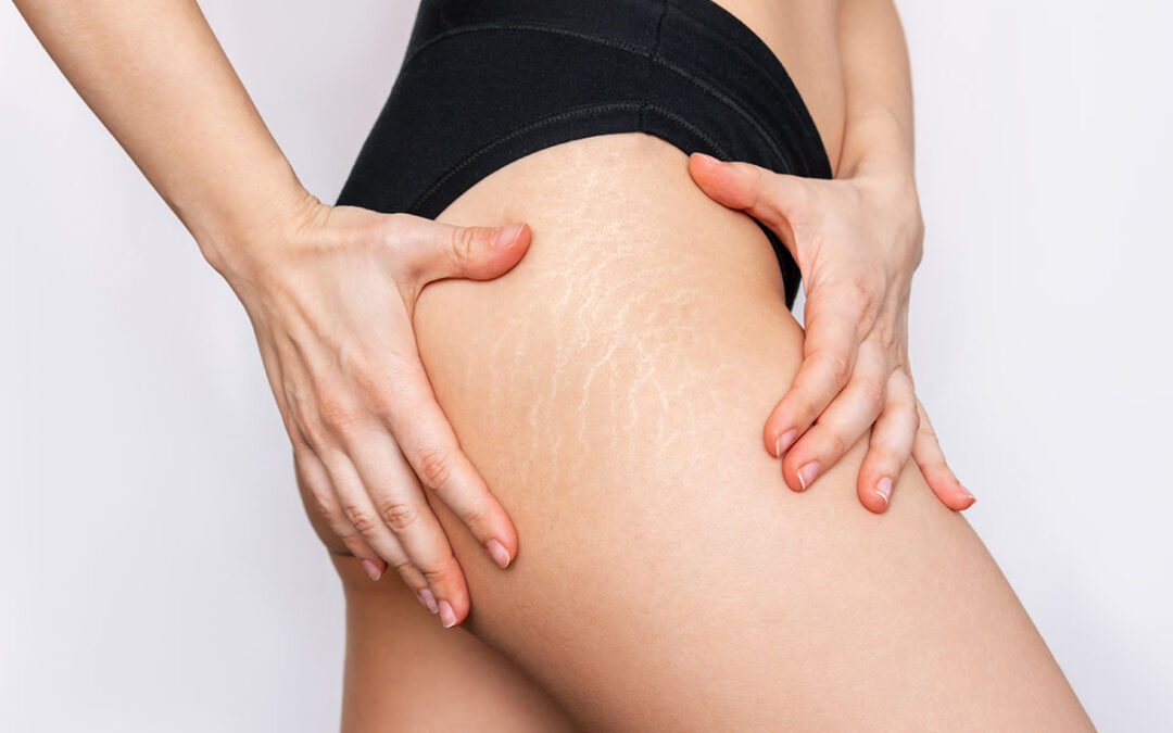 Young woman with white stretch marks from a weight loss or weight gain on her thigh