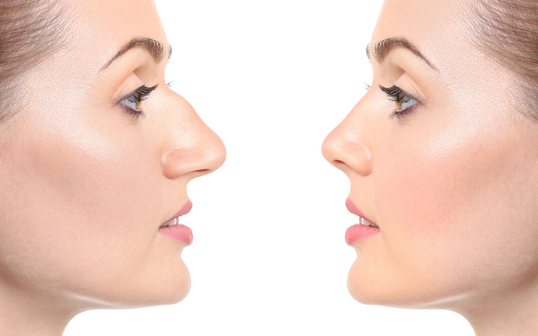 Young woman before and after rhinoplasty