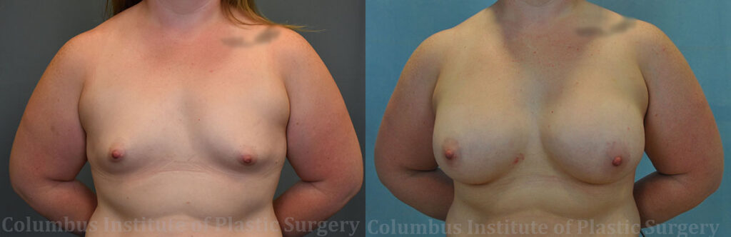 Breast Augmentation before and after photo by Columbus Institute of Plastic Surgery in Columbus, OH