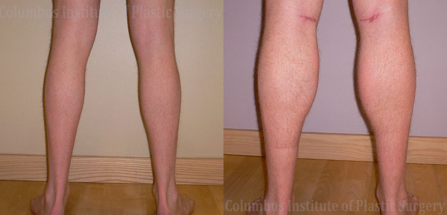 Calf Augmentation (Implants) before and after photo by Columbus Institute of Plastic Surgery in Columbus, OH