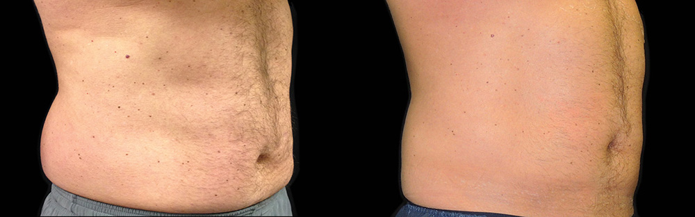 CoolSculpting before and after photo by Columbus Institute of Plastic Surgery in Columbus, OH