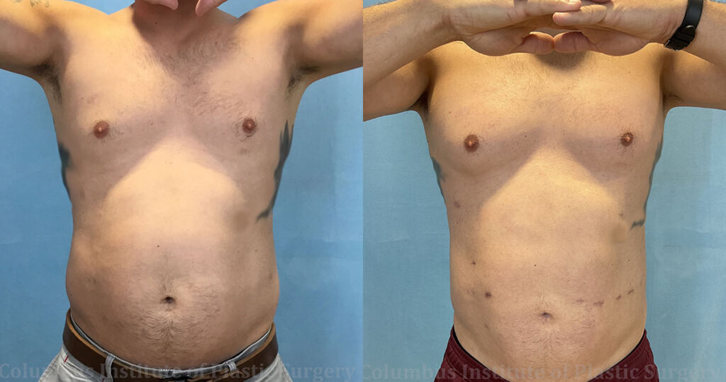 Liposuction before and after photo by Columbus Institute of Plastic Surgery in Columbus, OH