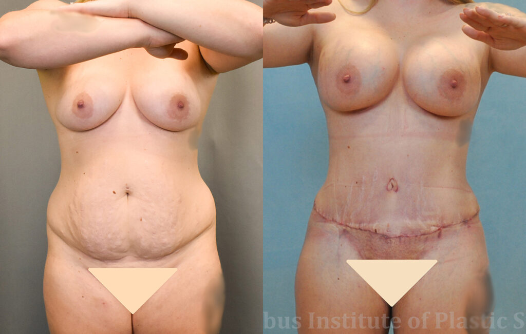 Mommy Makeover before and after photo by Columbus Institute of Plastic Surgery in Columbus, OH
