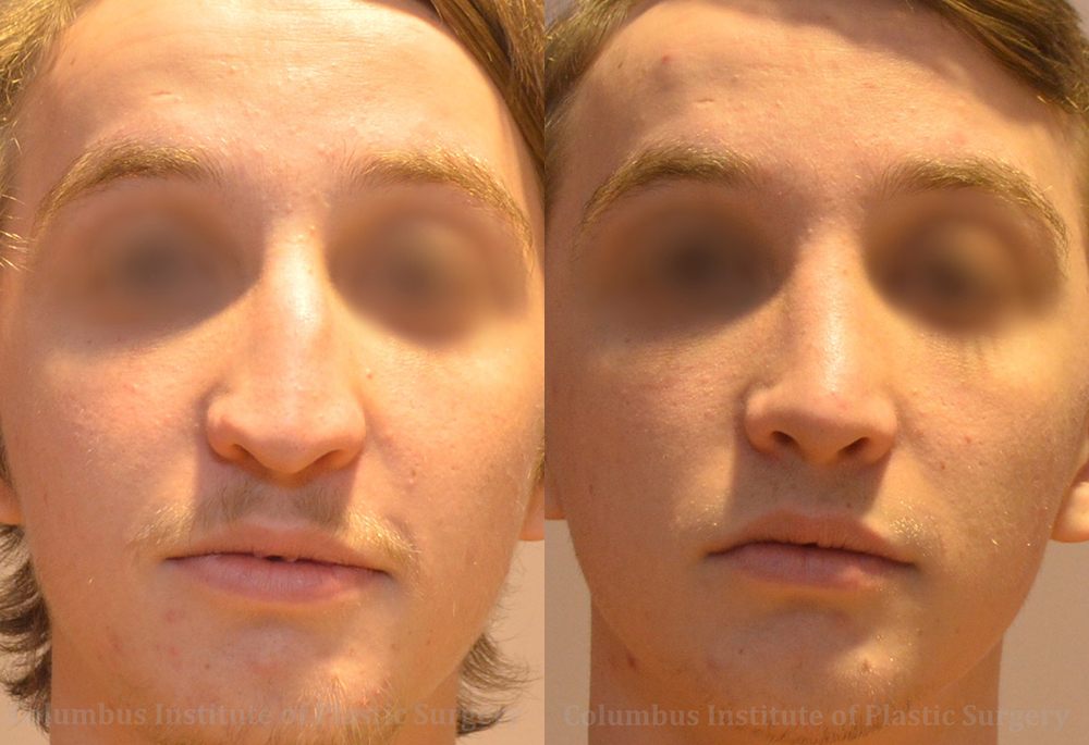 Rhinoplasty before and after photo by Columbus Institute of Plastic Surgery in Columbus, OH