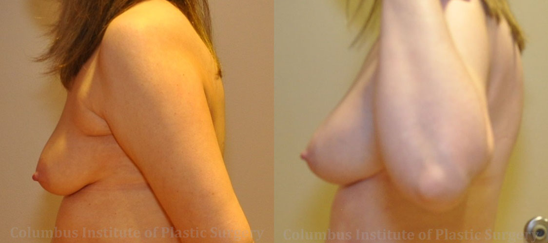 Breast Augmentation with Fat Grafting before and after photo by Columbus Institute of Plastic Surgery in Columbus, OH Breast Augmentation with Fat Grafting before and after photo by Columbus Institute of Plastic Surgery in Columbus, OH