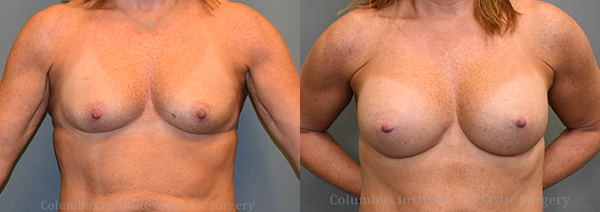 Breast Augmentation before and after photo by Columbus Institute of Plastic Surgery in Columbus, OH