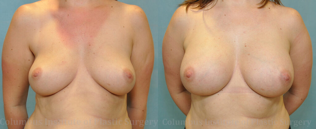 Breast Augmentation before and after photo by Columbus Institute of Plastic Surgery in Columbus, OH