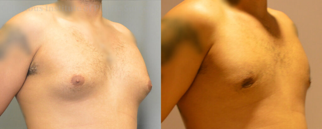 Gynecomastia before and after photo by Columbus Institute of Plastic Surgery in Columbus, OH