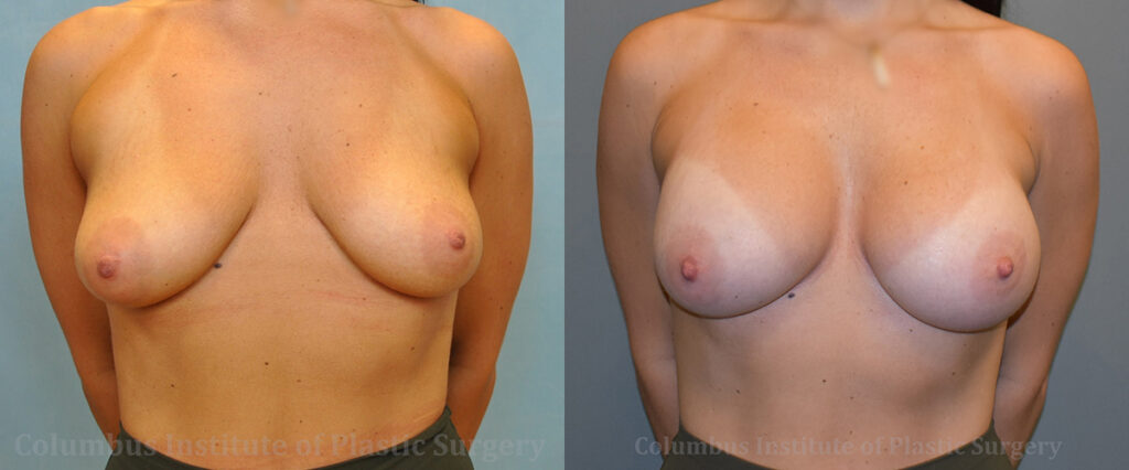 Breast Augmentation before and after photo by Columbus Institute of Plastic Surgery in Columbus, OH