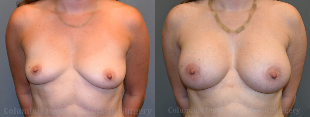 Breast Augmentation before and after photo by Columbus Institute of Plastic Surgery in Columbus, OH