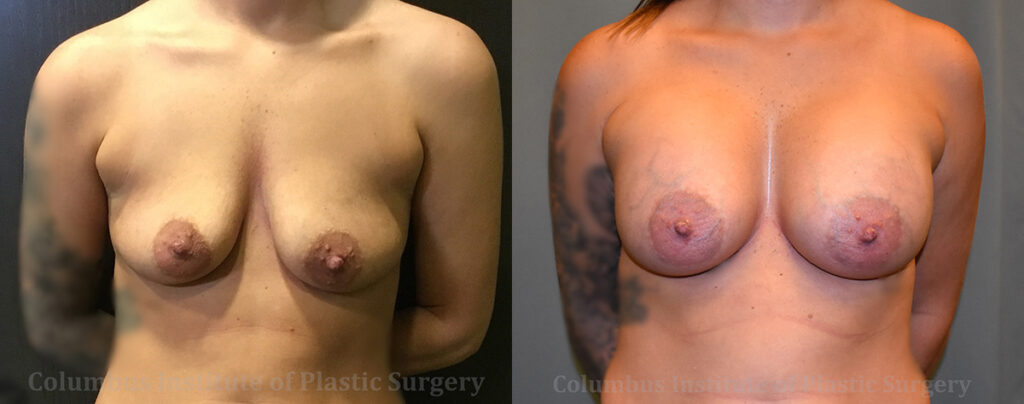 Breast Augmentation before and after photo by Columbus Institute of Plastic Surgery in Columbus, OH