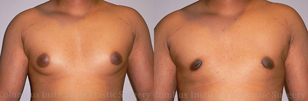 Gynecomastia before and after photo by Columbus Institute of Plastic Surgery in Columbus, OH